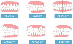 braces process
