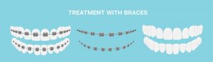 what is the process of getting braces