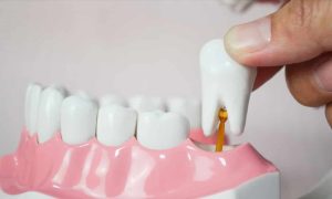free wisdom teeth removal